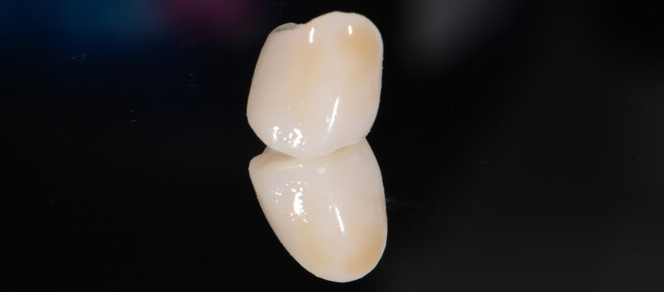 Fig. 5: Premolar restoration after glazing (OPTIGLAZE).