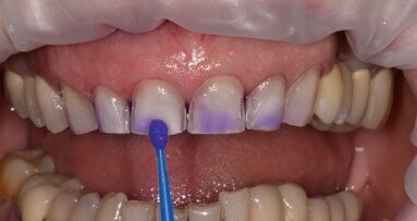 Làm sạch các phục hình răng cố định không có kim loại trước khi thực hiện các thủ thuật liên kết