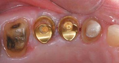 Leczenie odcinka bocznego szczęki z zastosowaniem Encode® Complete Restorative System
