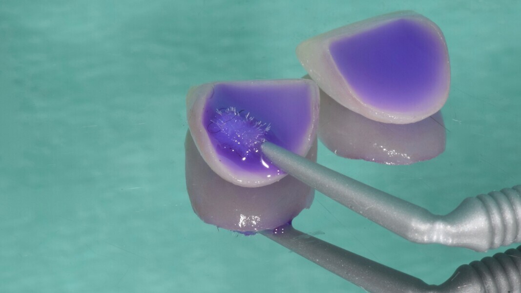 Fig. 5: Use of KATANA Cleaner to remove remains of try-in gel and contaminants, such as saliva, from the bonding surfaces of the fixed dental prostheses.