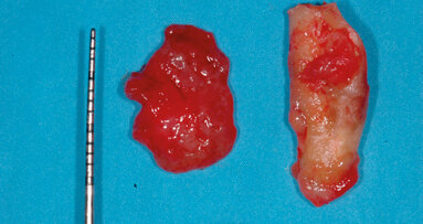 La tecnica di preservazione crestale associata alla chirurgia guidata per la sostituzione di un dente gravemente compromesso