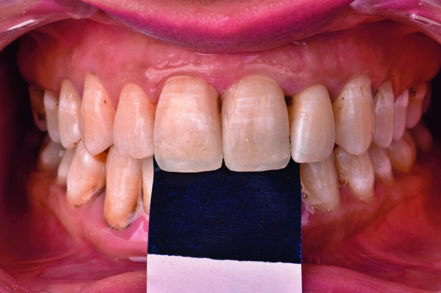 Fig 5. Occlusion and high points checked with articulating paper