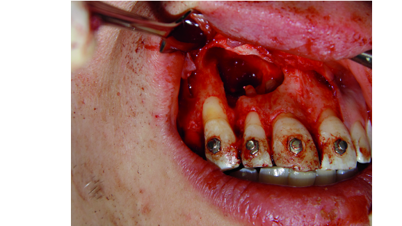 Interdisciplinary approach to treatment of maxillary radicular cysts: Minimization of surgical invasiveness and medication load