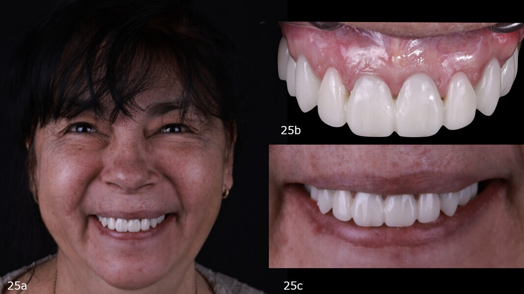 Fig. 25: Re-evaluation of the aesthetics for correction. Teeth still too far to the anterior, extending too far over the lower lip and no buccal corridors.