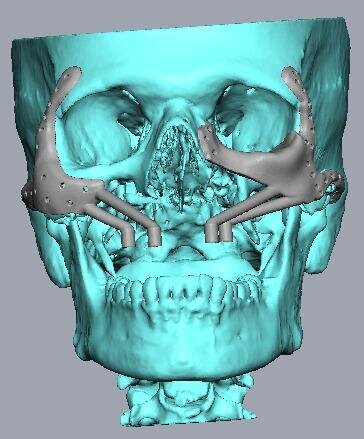 Fig 6 3D planning for patient specific subperiosteal implants