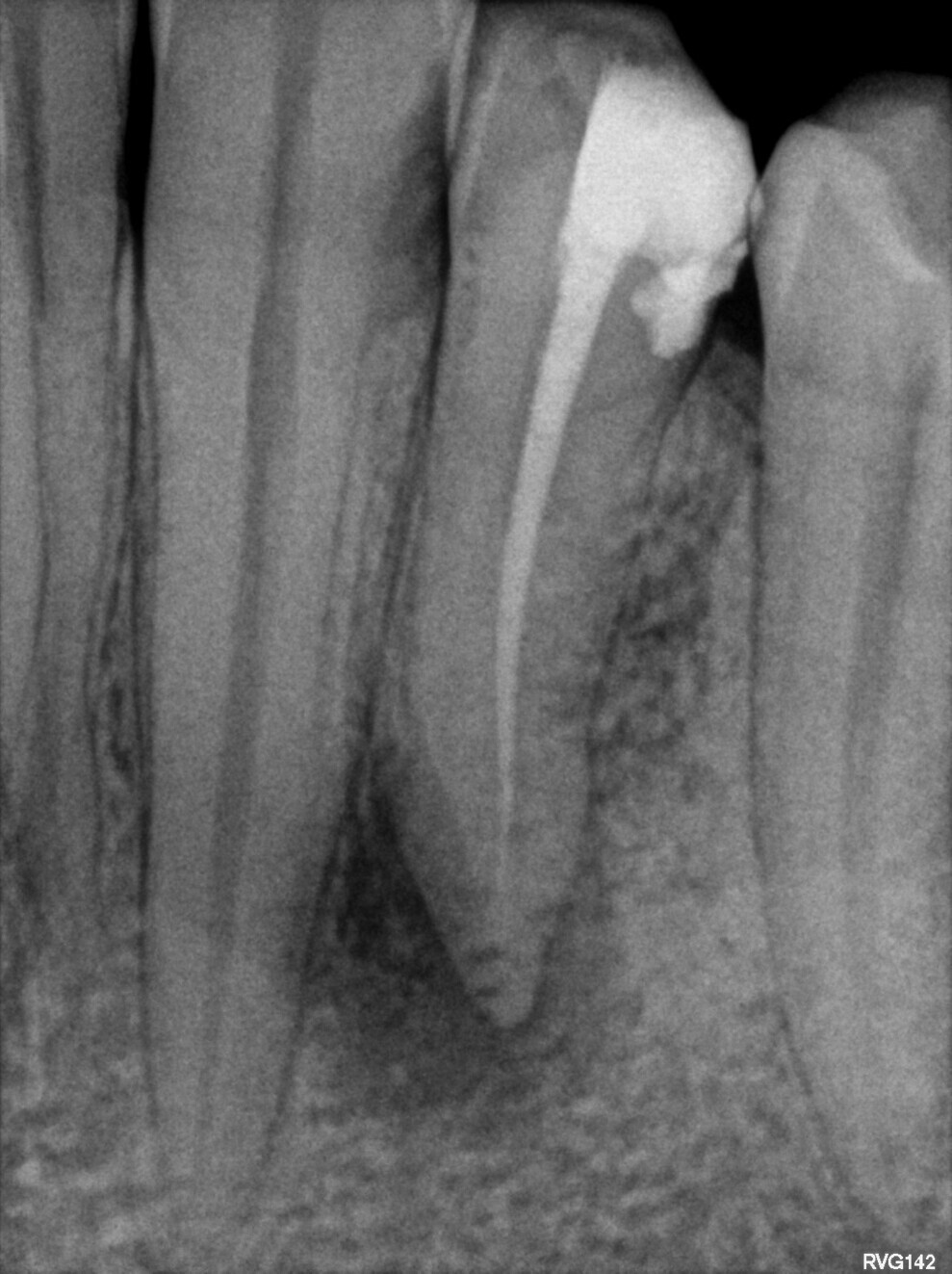 Fig 2: Pre-op radiograph