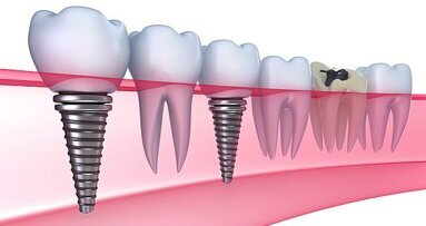 Implantaten weer vergoed door VGZ