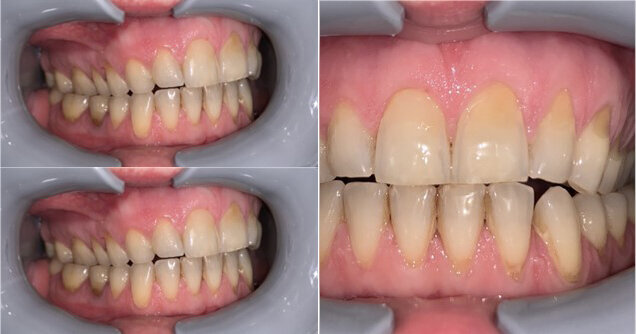 Fig. 3_Rapporti occlusali della paziente, classe II canina e molare a destra con crossbite, openbite, overjet aumentato, linea mediana inter-incisiva inferiore deviata a destra.