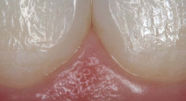 Fig. 16: Interdental papilla after one month
