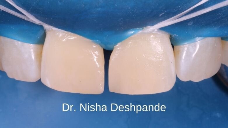 Front wing technique for direct diastema closures - Dr. Nisha Deshpande