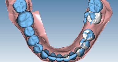 Progettazione ortodontica digitale di un caso di scissor bite