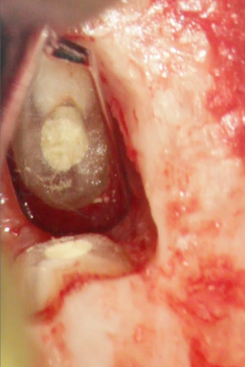 Fig. 4e: (a) Pre-op radiograph with a large periradicular lesion. (b) Periapical surgery. (c) MTA application with the MAP System and PD MTA White. (d) Condensation of the MTA with pluggers. (e) Mirror view of the root-end cavity filled with MTA. (f) Post-op radiograph showing the root-end filling.