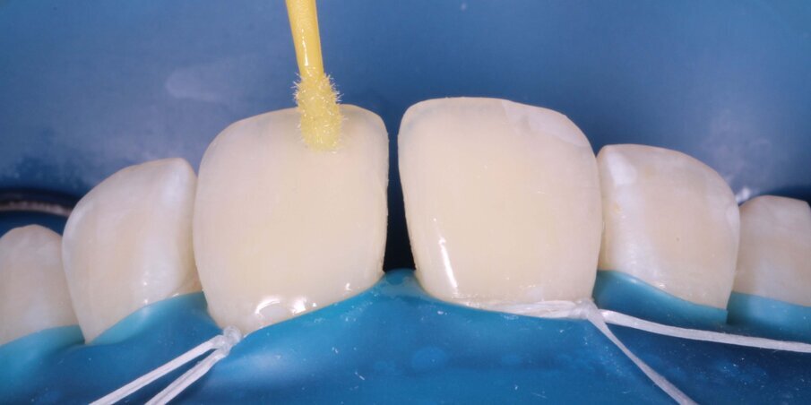 Fig 6. Applying the bonding agent