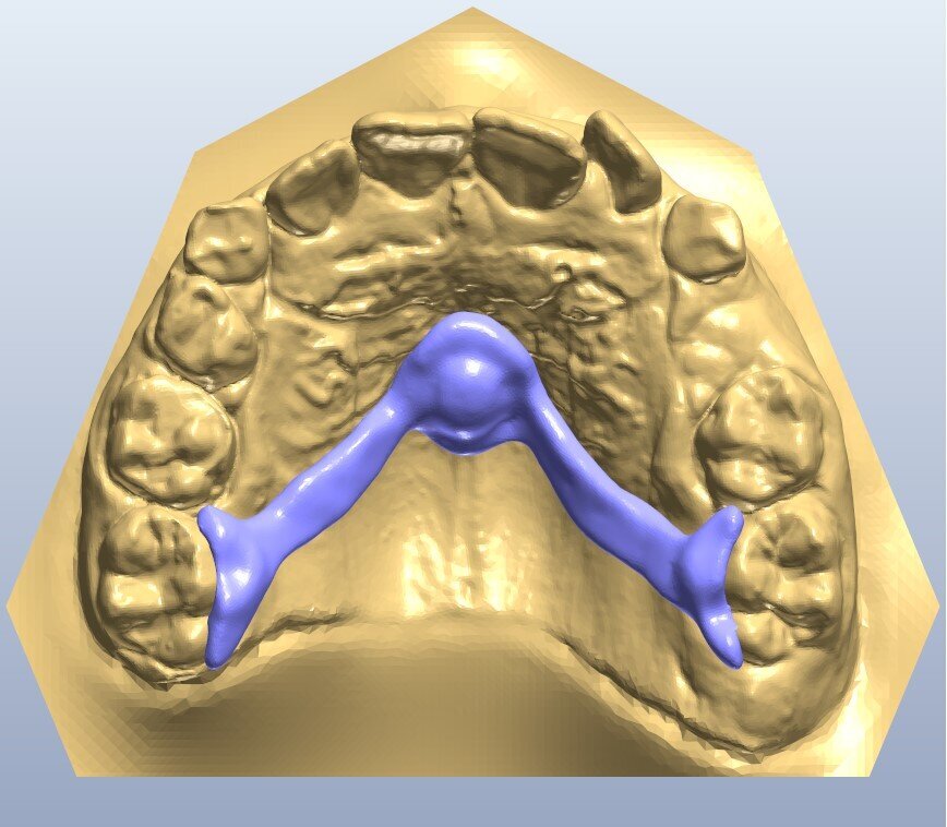 Fig. 16_Progetto CAD della barra di Nance customizzata.