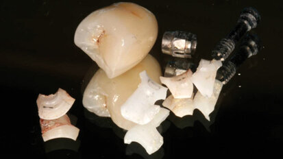 Precautions for using zirconia implant abutments
