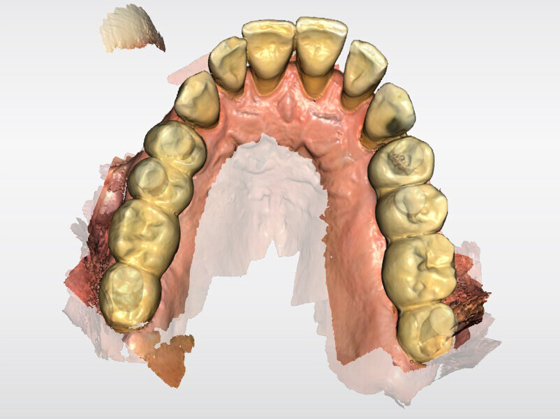 Fig. 11: Digital merging of the temporary bridge and tissue scan.