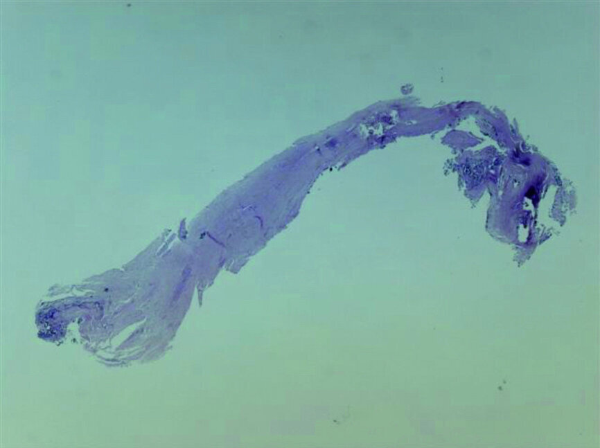 Fig. 20: Tissue removed from the endodontic space three months after transplantation (H&E stain; 2× magnification).
