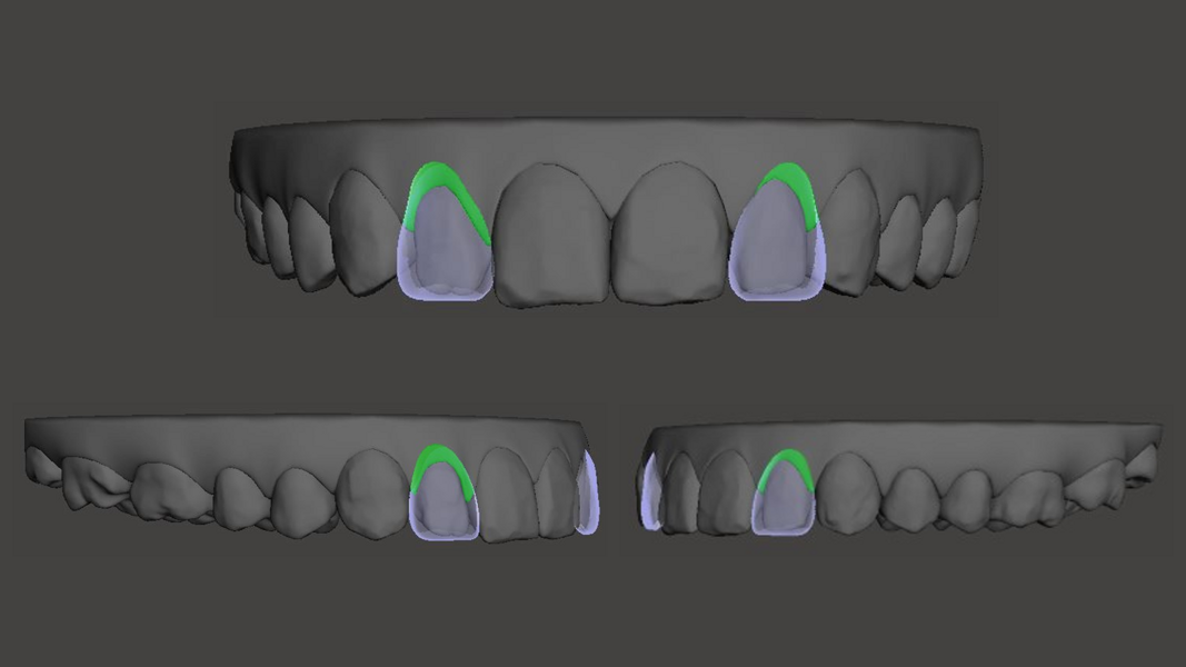 Fig. 44: Demonstrating the VISS protocols by showing the patient simulated soft-tissue recontouring of the eight maxillary anterior teeth to present to the patient as a treatment option.