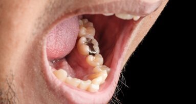 Adapting for the phase-down of dental amalgam