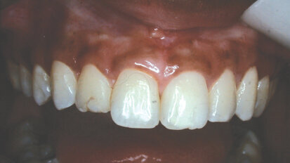 ‘Growing Enamel’ — Revisited