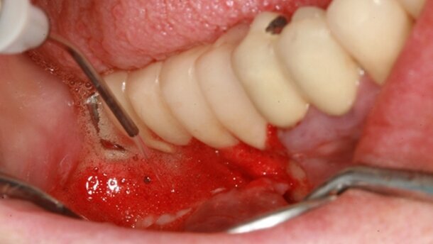 Traitement laser assisté des péri-implantites