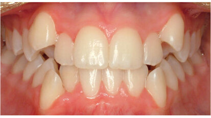 Why Dental Crowding Happens?