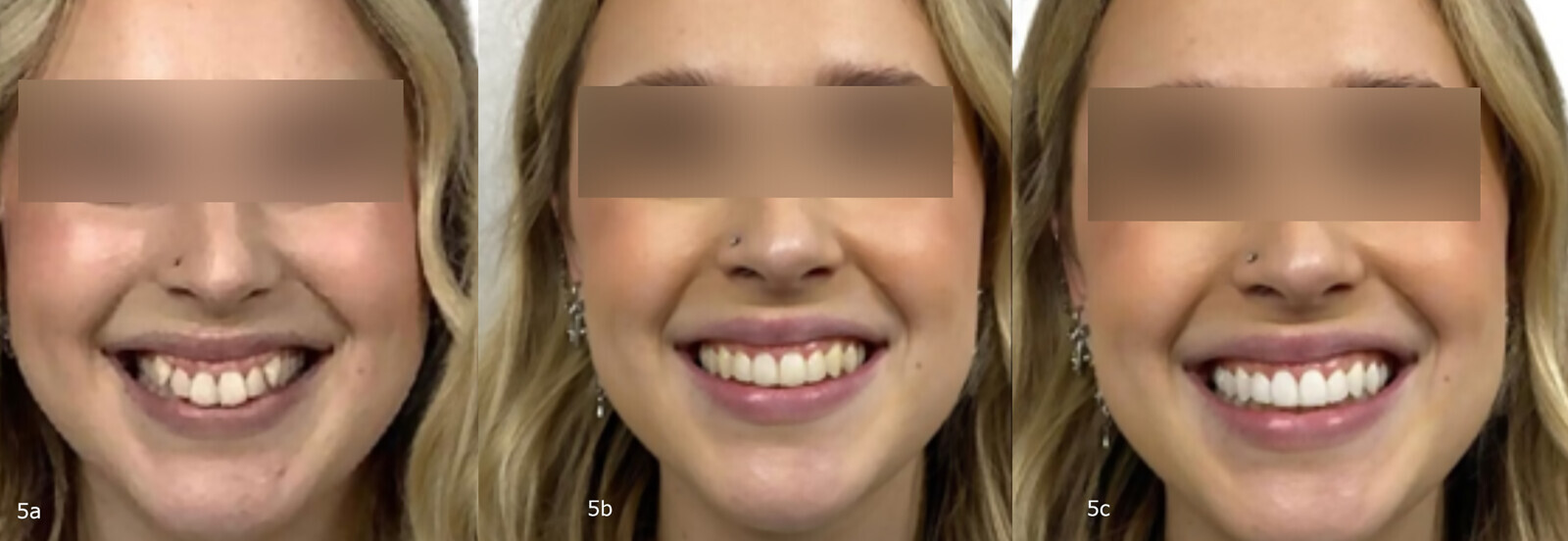 Figs. 5a–c: Extra-oral photographs: Before (a) and after (b & c).