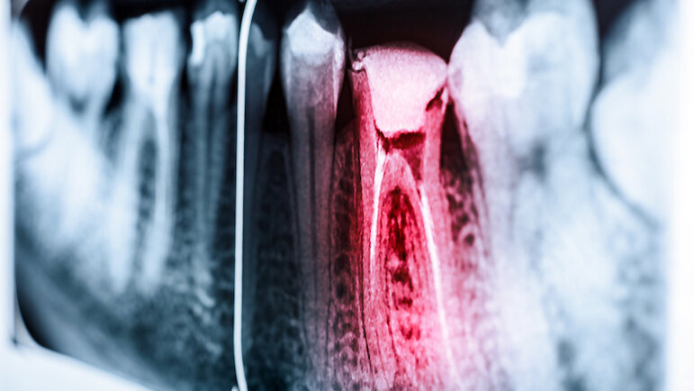 Smartphone sensor to detect tooth pain