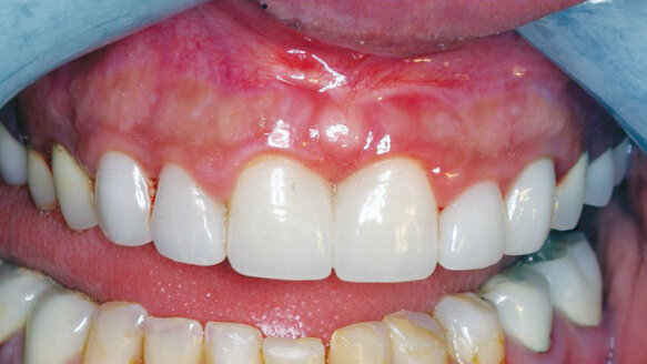 Unique maxillary frenectomy with a diode laser