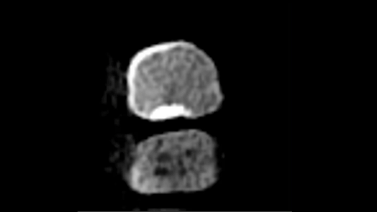 Fig. 2: Horizontal cross section taken from the i-CAT scan (DEXIS) showing total calcification of the root canal orifice at the level of the cemento-enamel junction, in comparison with the first molar.