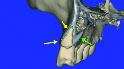 Improved CBCT diagnostic acuity with the ‘Lip-Lift’ technique