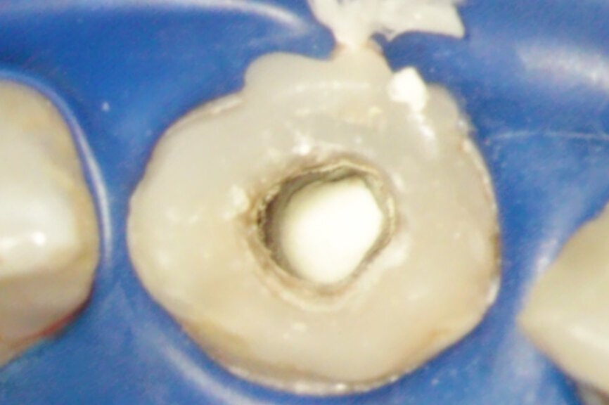 Fig. 2f: (a) Endodontically treated tooth with fistula. (b) After retreatment, the tooth showed an open apex. (c) MTA application with the MAP System and PD MTA White. Condensation of the MTA with pluggers (d) or paper points (e). (f) MTA plug. (g) Post-op radiograph showing the MTA plug and the reconstruction with a fibre post.