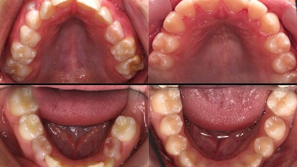 El Sistema Myobrace o la evolución en ortodoncia