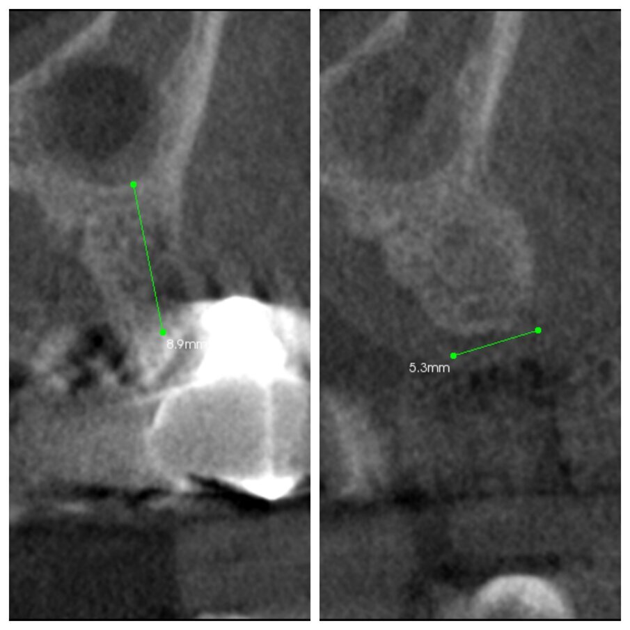 Fig. 2c_CBCT pre e post intervento a 6 mesi.