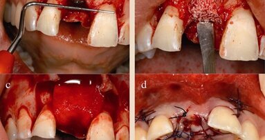 Neoss Implantat System mit klinischen und radiologischen 5-Jahres-Daten