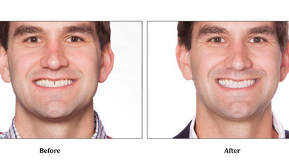 Company offers patients ‘do-it-at-home’ orthodontics