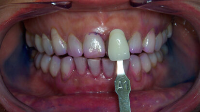 Nuove tecnologie cosmetiche di sbiancamento per il mantenimento di un sorriso estetico
