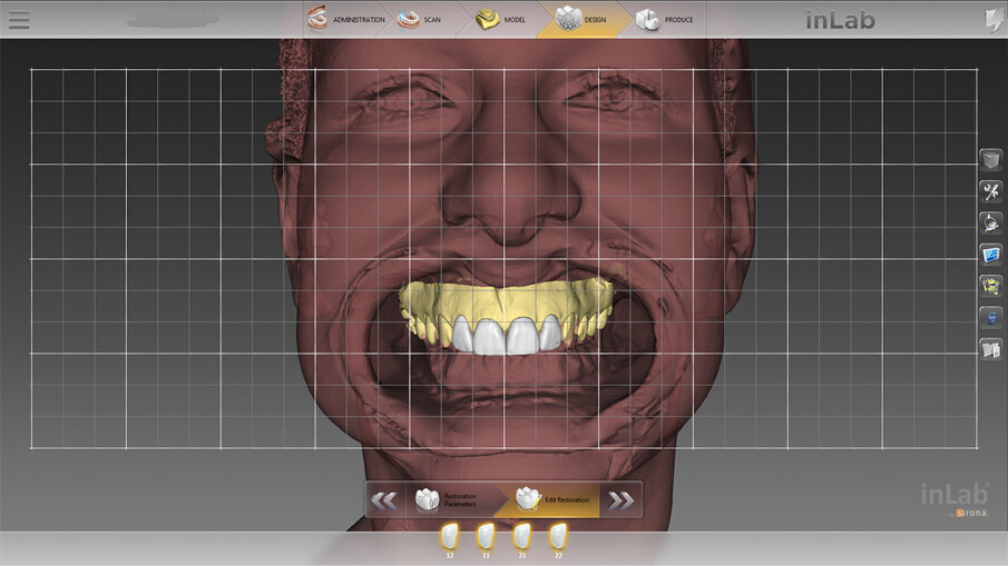Fig. 4: Face-Scan for setting up the occlusal plane and the patient’s midline.