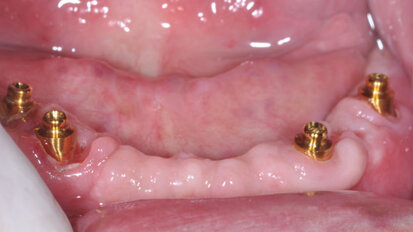Upper and lower dentures on Rhein83 components