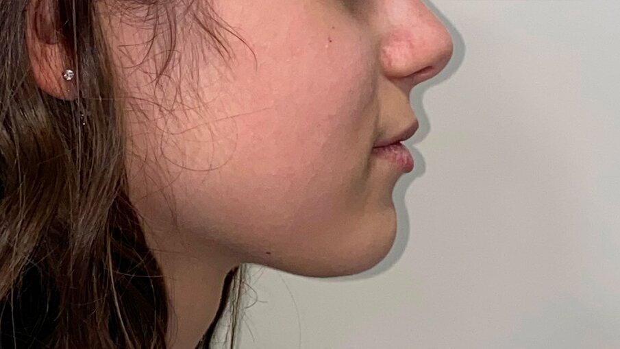 Fig. 16_Profilo post-trattamento.