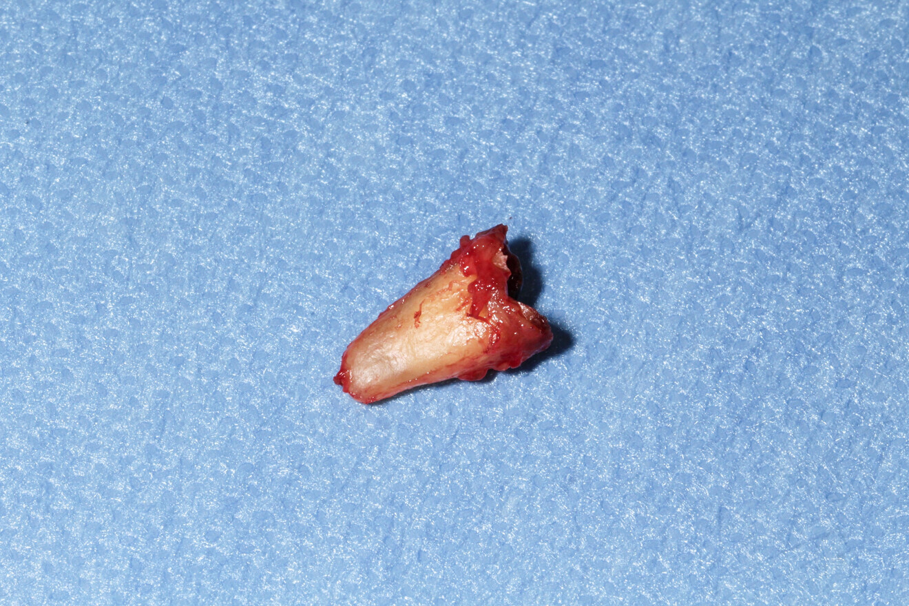 Fig. 1: Extracted root for radicular graft.