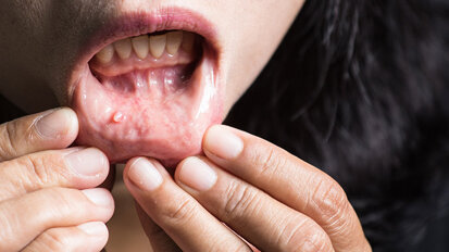 Artificial intelligence used to predict oral cancer survival chances