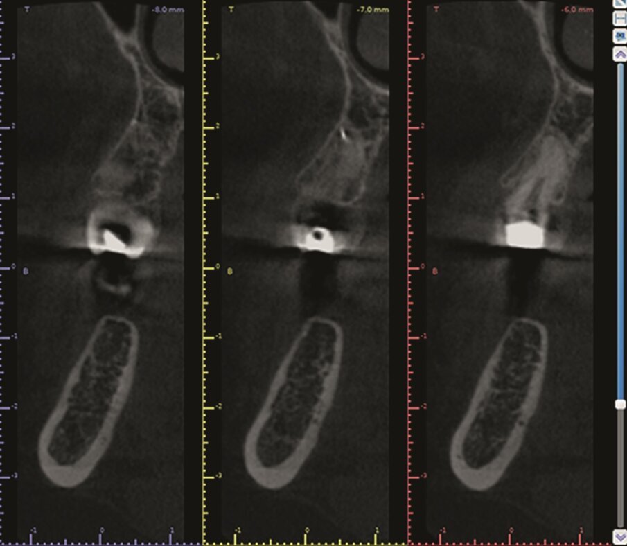 … and pre-op CBCT scan of tooth #15, sagital (b) …