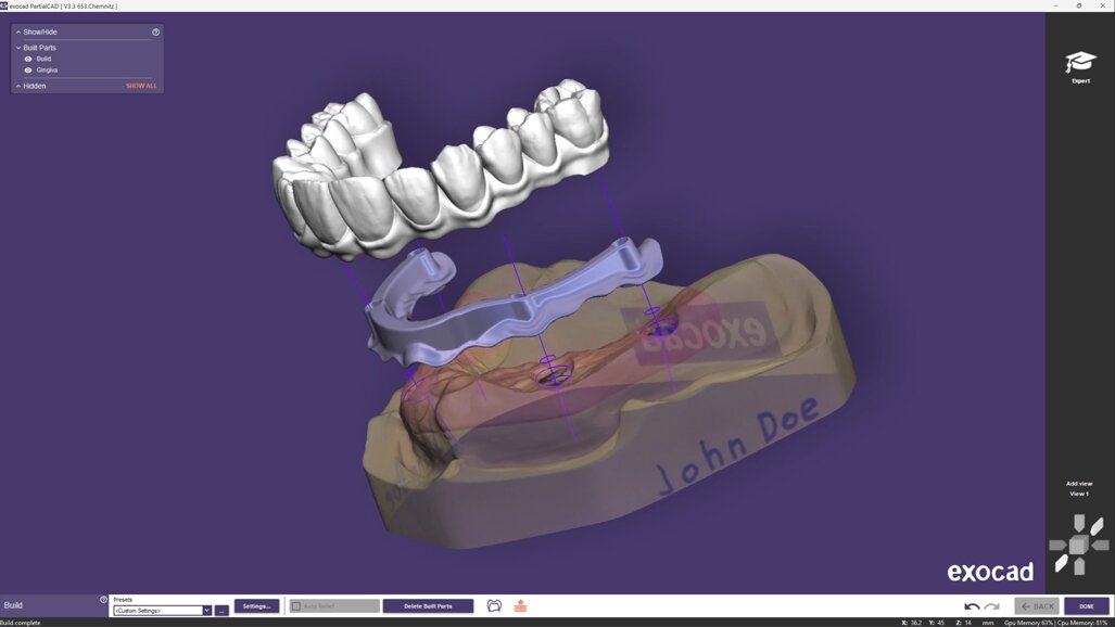 Exocad erweitert PartialCAD um automatisierten Split-Prothesen-Workflow