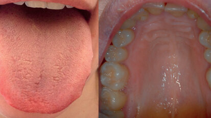 Burning Mouth Syndrome