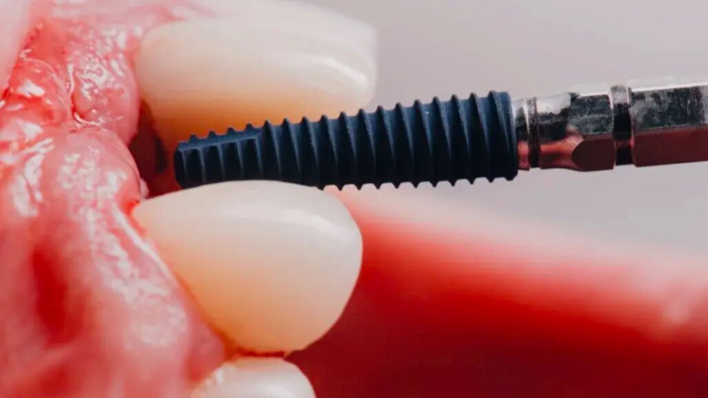 Mais de 10.000 implantes dentários colocados usando o sistema robótico Yomi