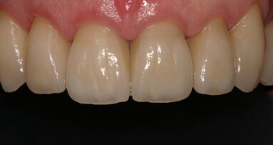 Using provisional restorations in complex restorative cases