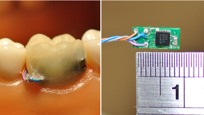 Sensor dental chinês pode facilitar o monitoramento do paciente