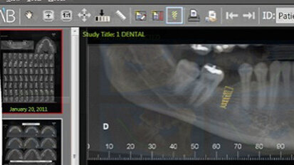 Low-price implants gaining interest