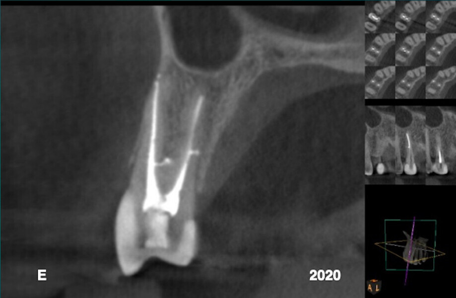 Fig. E : Une radiographie périapicale postopératoire prise en 2020 a montré une régénération osseuse et une reformation du desmodonte dans le défaut infraosseux qui était présent le long de la paroi distale de la racine